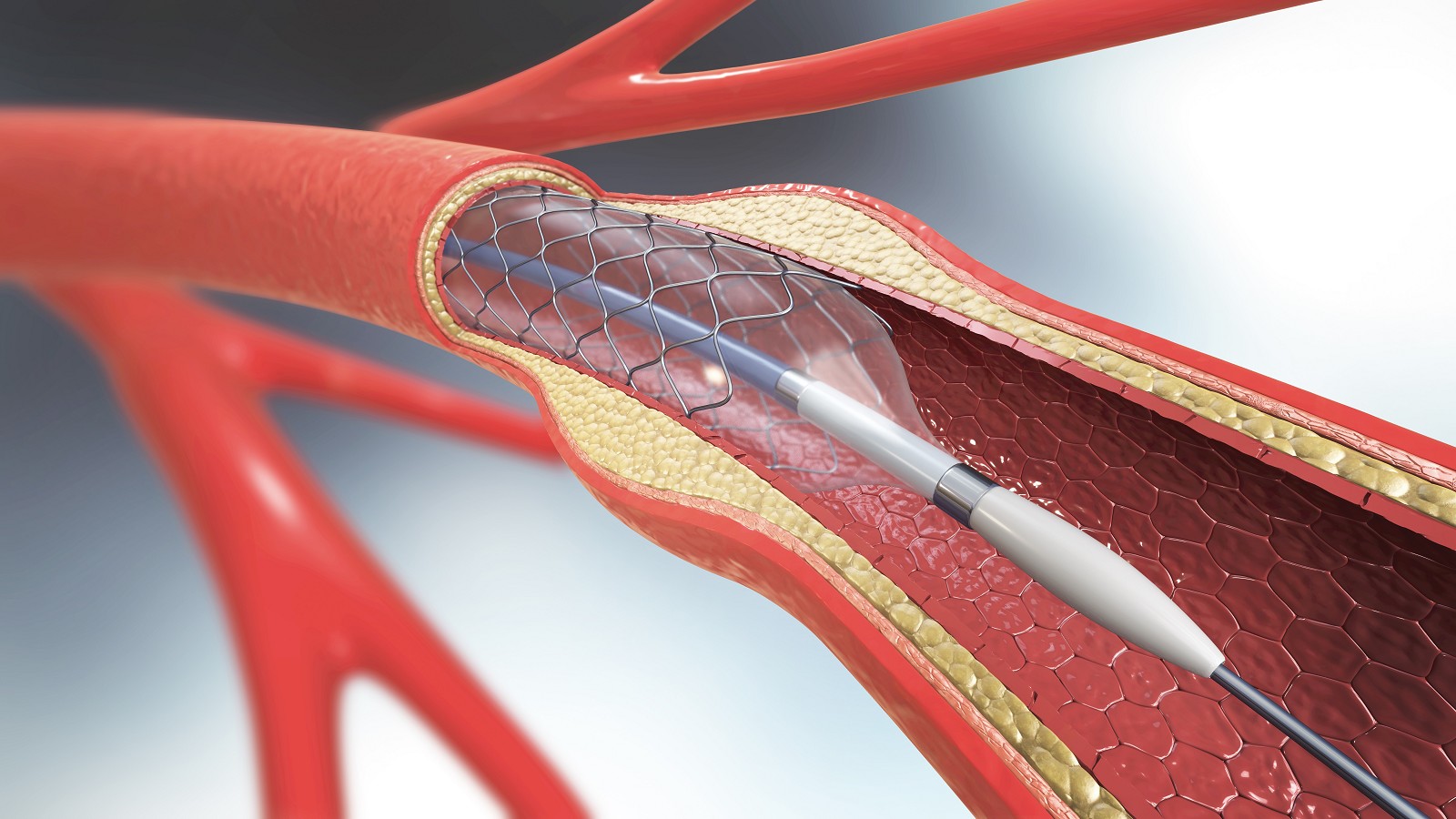 EVT - Advancements in Stroke Care in Northwestern Ontario